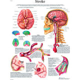 3B® Anatomical Chart - Stroke Chart, Laminated