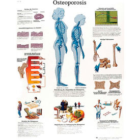 3B® Anatomical Chart - Osteoporosis, Paper