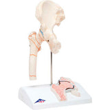 3B® Anatomical Model - Femoral Fracture and Hip Osteoarthritis