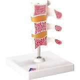 3B® Anatomical Model - Deluxe Osteoporosis (3 Vertebrae)