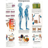 3B® Anatomical Chart - Osteoporosis, Laminated